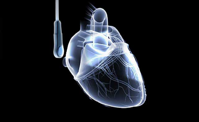 ما هو تخطيط صدى القلب؟