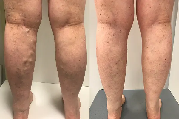 علائم واریس پا: از رگ‌های برجسته تا خارش و تورم