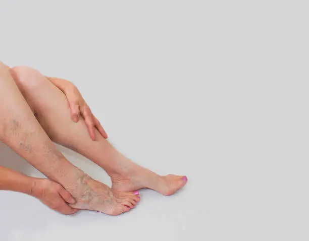 واریس پا چیست؟