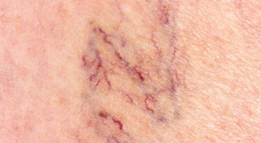 واریس عنکبوتی چیست؟