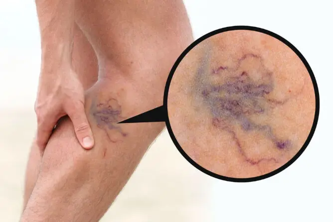 واریس عنکبوتی چیست؟ علت + عوارض+ بهترین روش های درمان