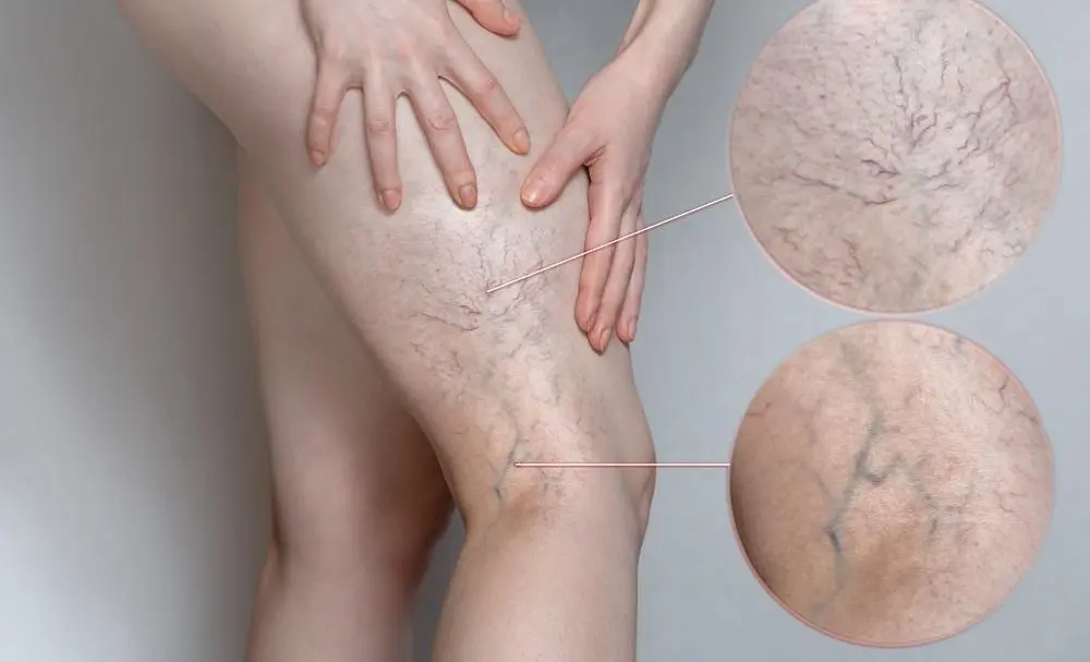 درمان سریع واریس