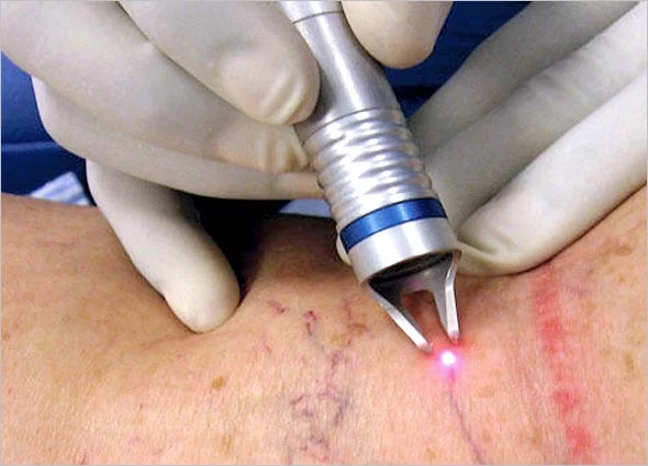 درمان واریس با لیزر