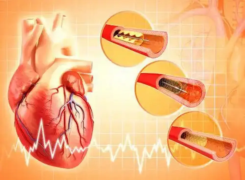 استنت قلب چیست؟ عوارض+ طول عمر+ تعویض آن ( تمام نکات)