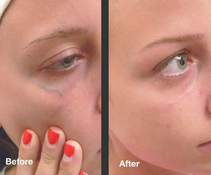 درمان واریس صورت