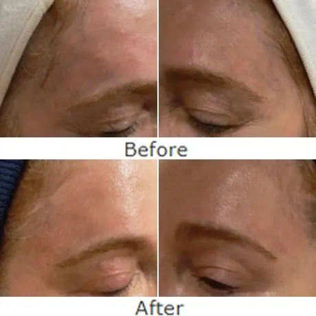 درمان واریس صورت