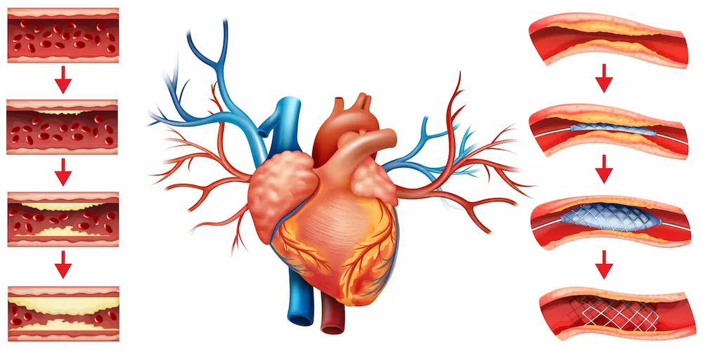 علائم گرفتگی رگ قلب