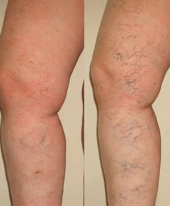 واریس ران پا1