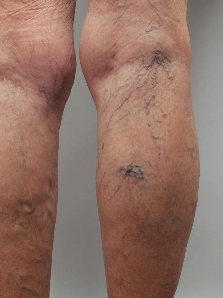 واریس پشت زانو