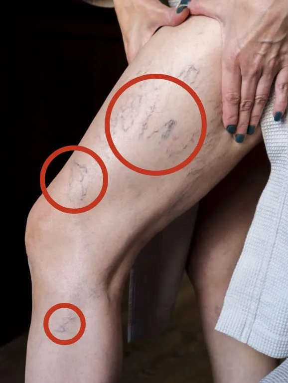 واریس ران پا