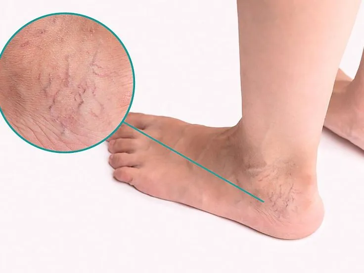 واریس کف پا2