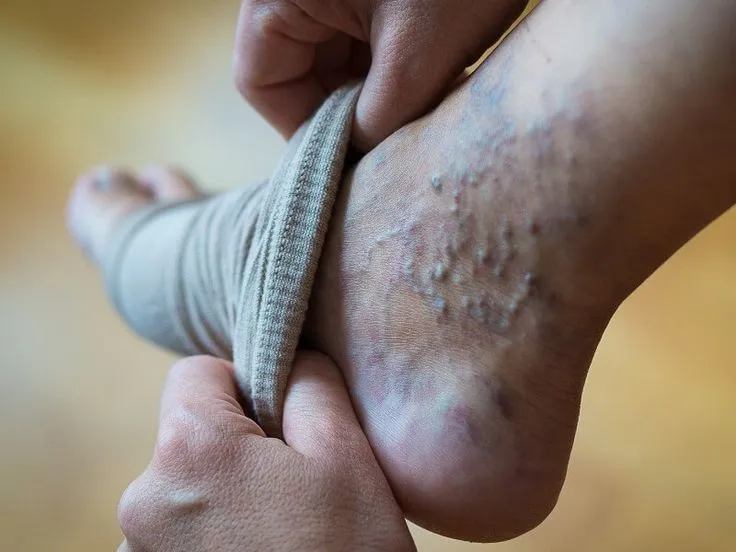 واریس کف پا1