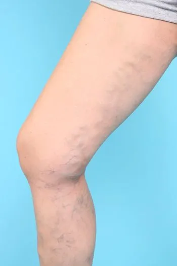 واریس ران پا2