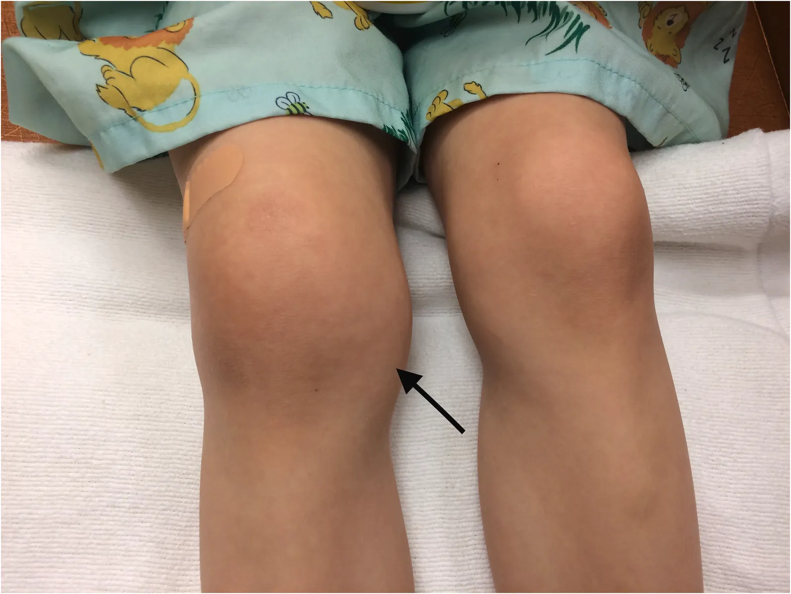 زانو درد در تب روماتیسمی